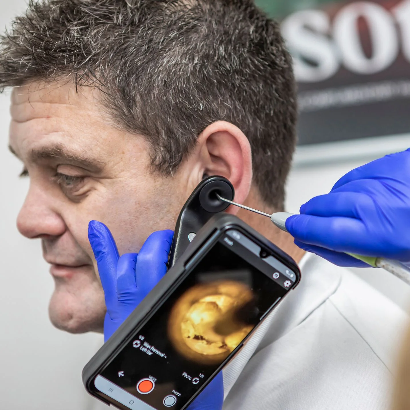 Close‑up of digital otoscope showing ear canal on smartphone screen during examination.
